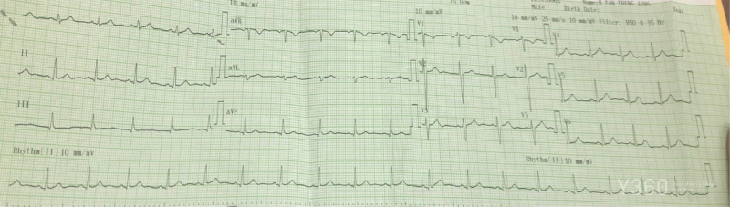Các dấu hiệu chẩn đoán Tamponade cần được đánh giá nhanh chóng và chính xác.