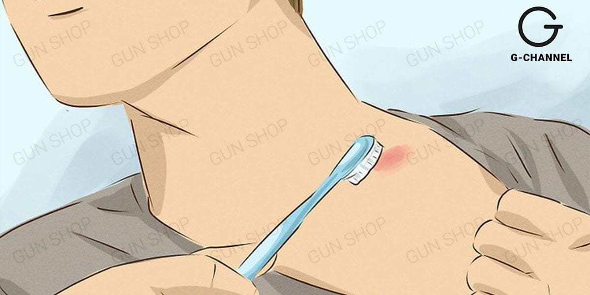 Vết hickey đỏ sẫm trên da cho thấy bản chất vết bầm tím