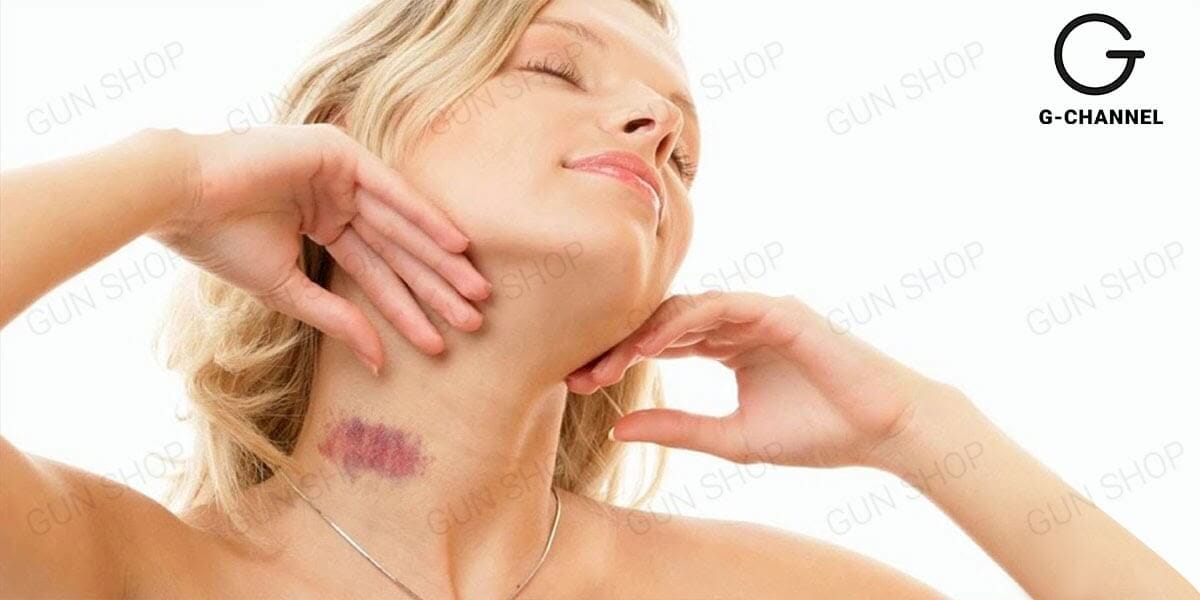 Hickey trên cổ với nguy cơ và dấu hiệu nhận biết