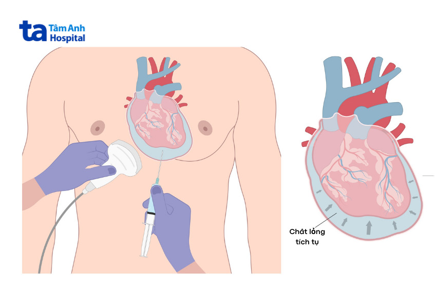 Chọc hút dịch màng ngoài tim giúp loại bỏ dịch gây chèn ép tim là phương pháp điều trị cấp cứu hiệu quả.